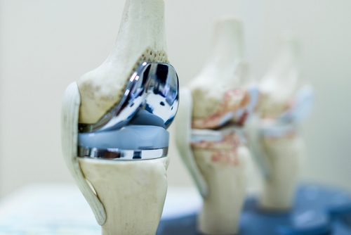 Medical model demonstrating total knee replacement surgery