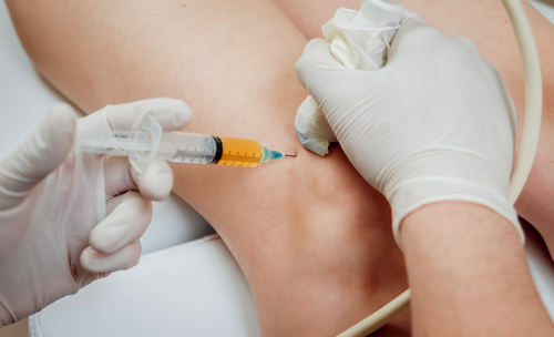 PRP injection in the knee guided by ultrasound imaging